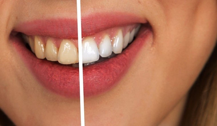 7 Foods and Drinks That Stain Your Teeth