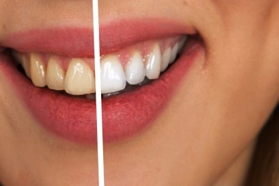 7 Foods and Drinks That Stain Your Teeth